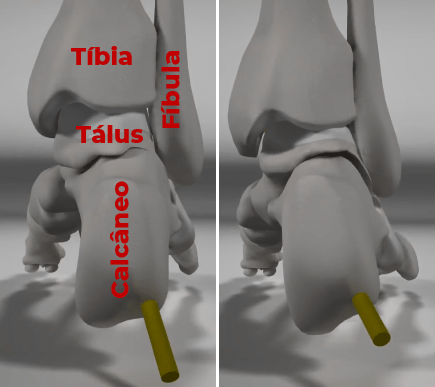 Articulações do Tornozelo e Subtalar: Tálus como conversor de torque - vista posterior.