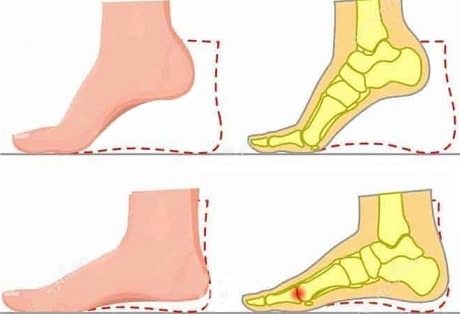 Comparação entre o movimento normal e a condição conhecida como functional hallux limitus